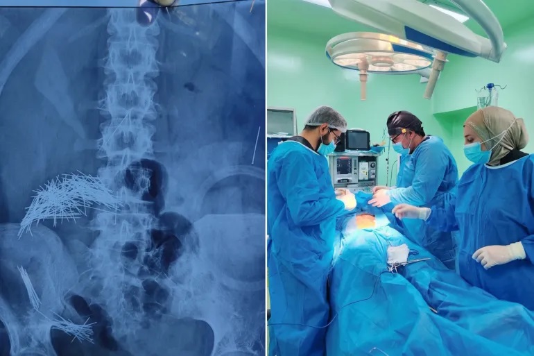 فريق طبي عراقي يستخرج 214 إبرة ودبوساً من بطن رجل