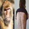 توضيح هام صادر عن وزارة الصحة بشأن الاشتباه بالإصابة بمرض جدري القرود 